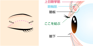 埋没法